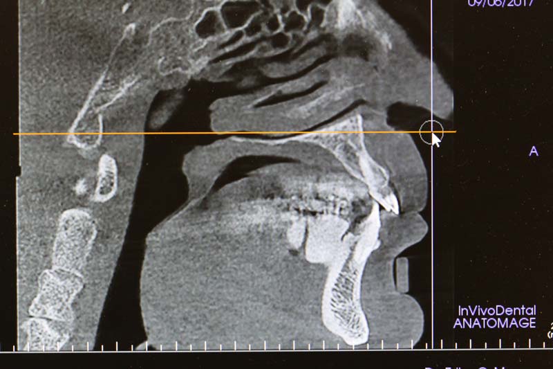 CBCT Scan | Sleep Apnea | Richmond, VA